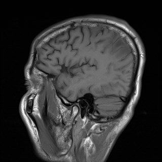 File:Cerebral toxoplasmosis (Radiopaedia 43956-47461 Sagittal T1 17).jpg