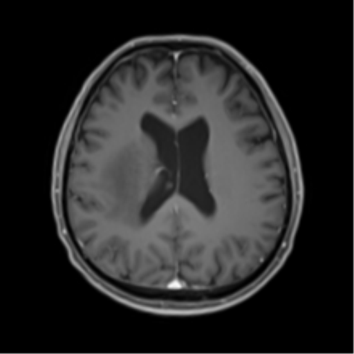 Cerebral toxoplasmosis (Radiopaedia 54575-60804 Axial T1 C+ 35).png