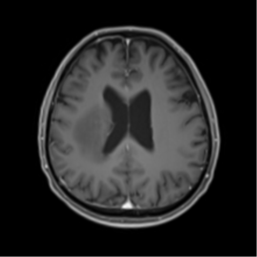 Cerebral toxoplasmosis (Radiopaedia 54575-60804 Axial T1 C+ 36).png
