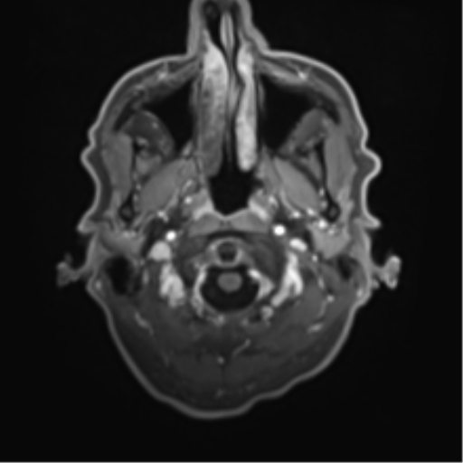Cerebral toxoplasmosis (Radiopaedia 54575-60804 Axial T1 C+ 7).png