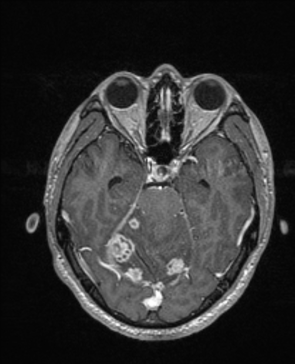 Cerebral toxoplasmosis (Radiopaedia 85779-101597 Axial T1 C+ 58).jpg