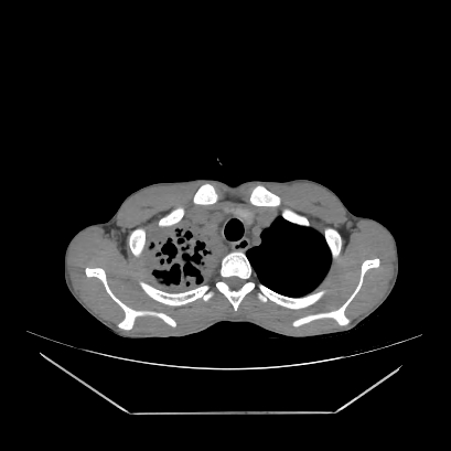 Cerebral tuberculoma (Radiopaedia 80829-94318 Axial non-contrast 8).jpg