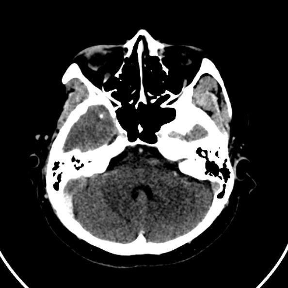 Cerebral venous hemorrhagic infarct from venous sinus thrombosis (Radiopaedia 55433-61883 Axial C+ delayed 112).jpg