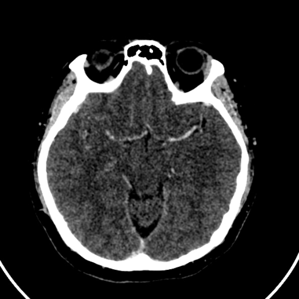 Cerebral venous hemorrhagic infarct from venous sinus thrombosis (Radiopaedia 55433-61883 Axial C+ delayed 90).jpg