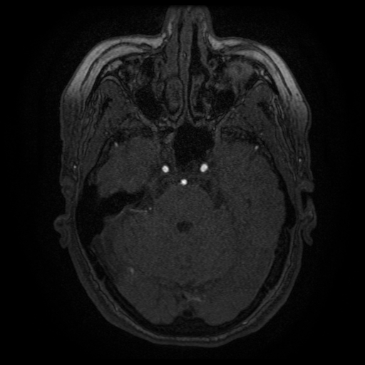 Cerebral venous infarction (Radiopaedia 25109-25363 MRA 17).jpg