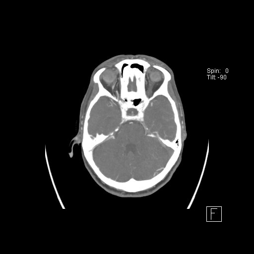 Cerebral venous infarction with hemorrhage (Radiopaedia 65343-74396 A 34).jpg