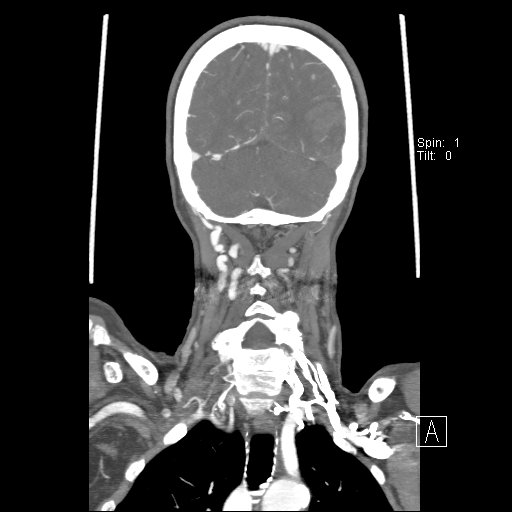 Cerebral venous infarction with hemorrhage (Radiopaedia 65343-74396 B 219).jpg