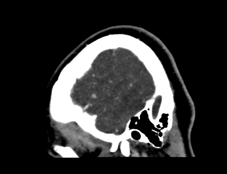 Cerebral venous sinus thrombosis (Radiopaedia 59224-66646 Sagittal C+ delayed 64).jpg