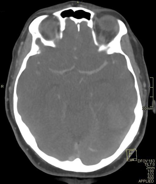 Cerebral venous sinus thrombosis (Radiopaedia 91329-108965 Axial venogram 34).jpg
