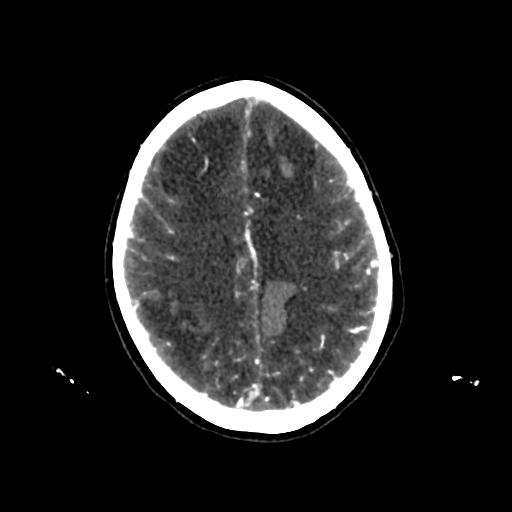 File:Cerebral venous throbmosis - hemorrhagic venous infarction (Radiopaedia 87318-103613 Axial CT venogram 26).jpg