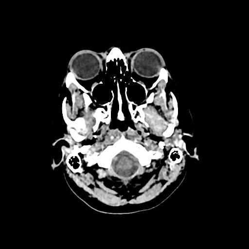 Cerebral venous throbmosis - hemorrhagic venous infarction (Radiopaedia 87318-103613 Axial non-contrast 14).jpg