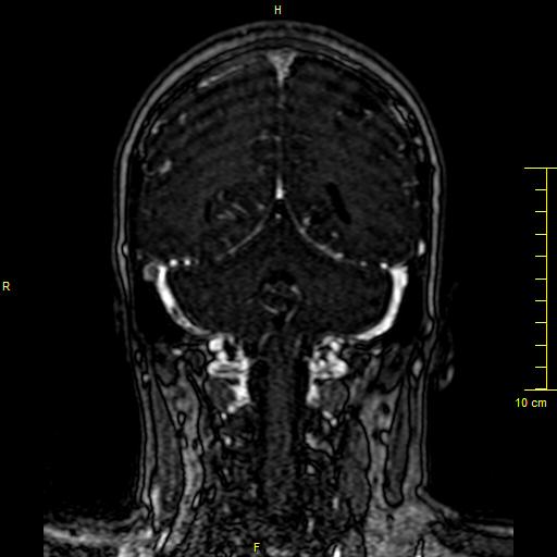 Cerebral venous thrombosis (Radiopaedia 23288-23351 MRV 117).JPG