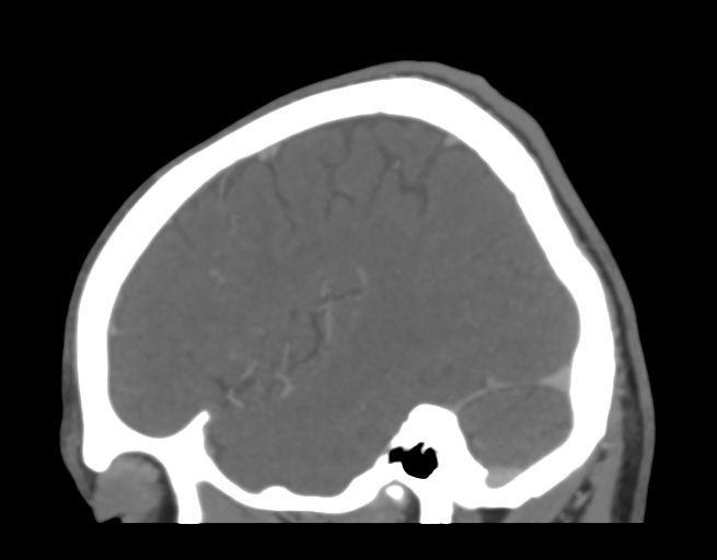 File:Cerebral venous thrombosis (Radiopaedia 38392-40467 D 41).png
