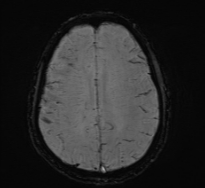 Cerebral venous thrombosis (Radiopaedia 71207-81504 Axial SWI 37).jpg