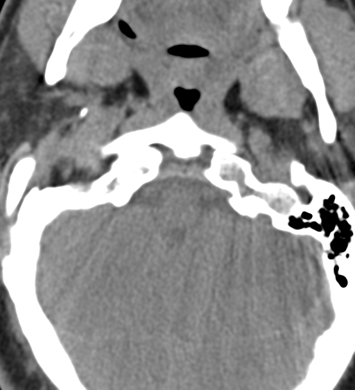 Cervical canal stenosis due to ossification of the posterior longitudinal ligament (Radiopaedia 47260-51823 Axial non-contrast 8).png