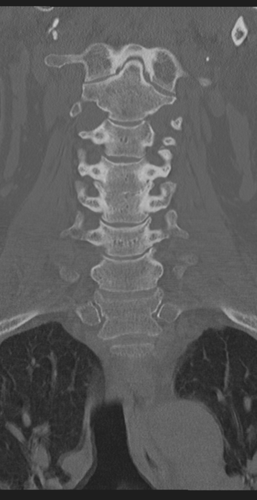 Cervical canal stenosis due to ossification of the posterior longitudinal ligament (Radiopaedia 47260-51823 Coronal bone window 22).png