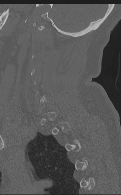 Cervical canal stenosis due to ossification of the posterior longitudinal ligament (Radiopaedia 47260-51823 Sagittal bone window 59).png
