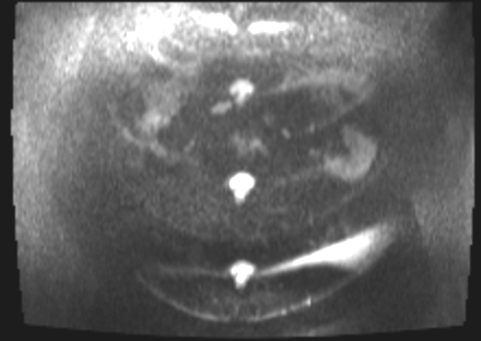 File:Cervical carcinoma (Radiopaedia 88312-104943 Axial DWI 1).jpg