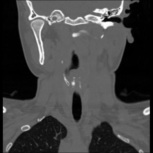 File:Cervical rib (Radiopaedia 71110-81363 Coronal non-contrast 32).jpg