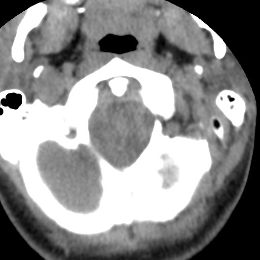Cervical schwannoma (Radiopaedia 57979-64974 Axial non-contrast 12).png