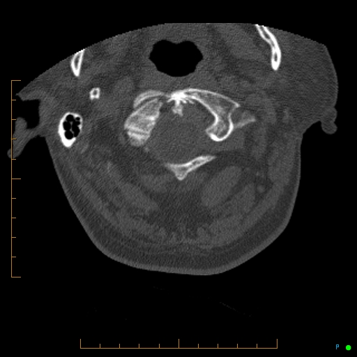 Cervical spine fracture - ankylosing spondylitis (Radiopaedia 76835-88706 Axial bone window 20).jpg