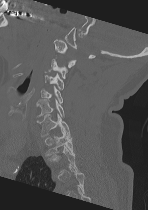 Cervical spine fractures with vertebral artery dissection (Radiopaedia 53296-59268 Sagittal bone window 44).png