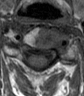 File:Cervical spine metastasis with vertebral artery encasement (Radiopaedia 14347).jpg