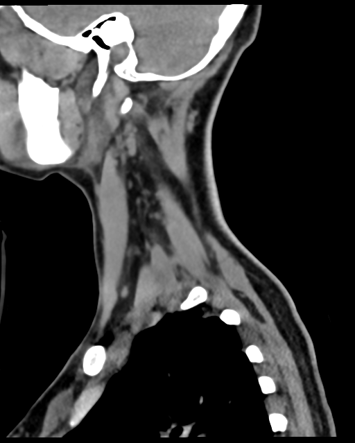 Cervical tuberculous spondylitis (Radiopaedia 39149-41365 D 59).png