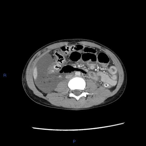 File:Chance fracture with duodenal and pancreatic lacerations (Radiopaedia 43477-46864 A 23).jpg