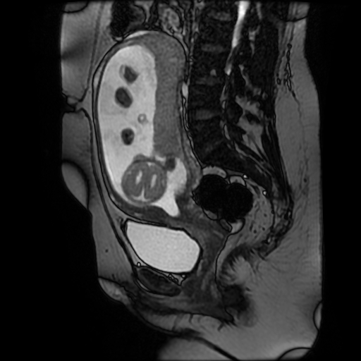 File:Chiari II malformation - fetal MRI (Radiopaedia 68099-77581 Sagittal Fiesta 28).jpg