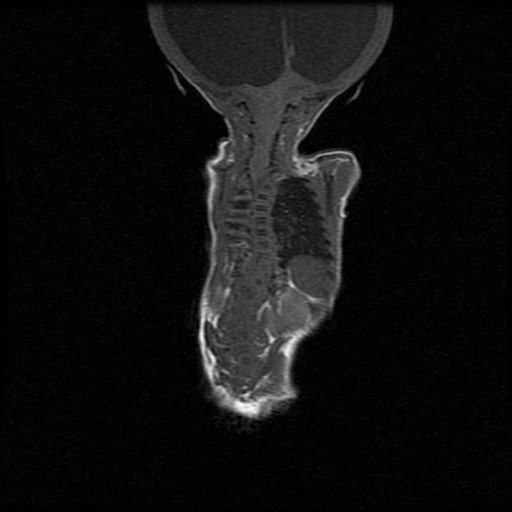 File:Chiari II malformation with spinal meningomyelocele (Radiopaedia 23550-23652 Coronal T1 6).jpg