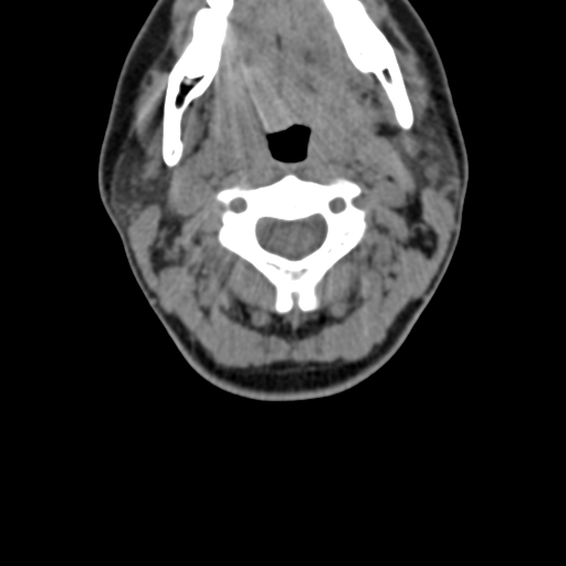 File:Chiari I malformation and obstructive hydrocephalus (Radiopaedia 41185-43981 D 41).png
