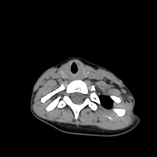 Chiari I with syrinx and skull base anomalies (Radiopaedia 89444-106412 Axial non-contrast 111).jpg