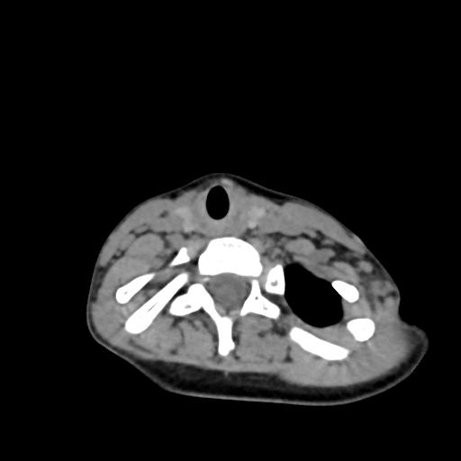 Chiari I with syrinx and skull base anomalies (Radiopaedia 89444-106412 Axial non-contrast 114).jpg