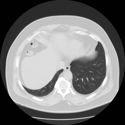 File:Chilaiditi’s syndrome (Radiopaedia 27550-27756 Axial lung window 16).jpg