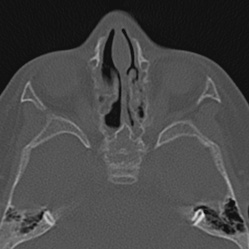 Choanal atresia (Radiopaedia 88525-105975 Axial bone window 59).jpg