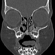 File:Choanal atresia (Radiopaedia 88525-105975 Coronal bone window 17).jpg