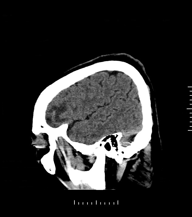Cholangiocarcinoma with cerebral metastases (Radiopaedia 83519-98628 C 46).jpg