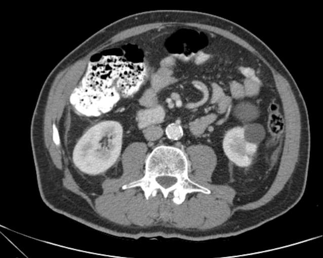 File:Cholecystitis - perforated gallbladder (Radiopaedia 57038-63916 A 44).jpg