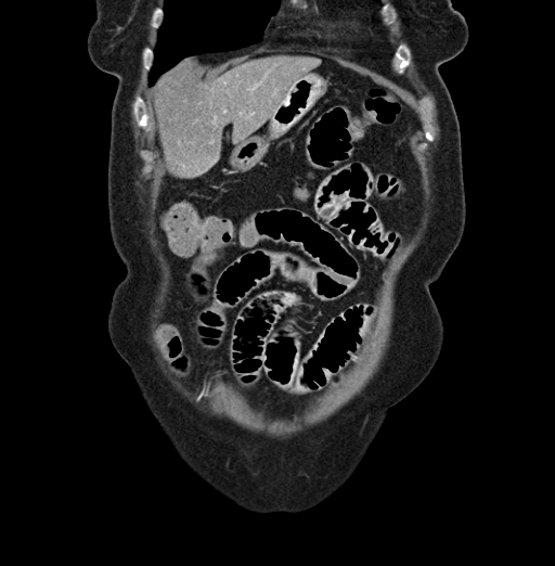 File:Cholecystoduodenal fistula due to calculous cholecystitis with gallstone migration (Radiopaedia 86875-103077 B 10).jpg