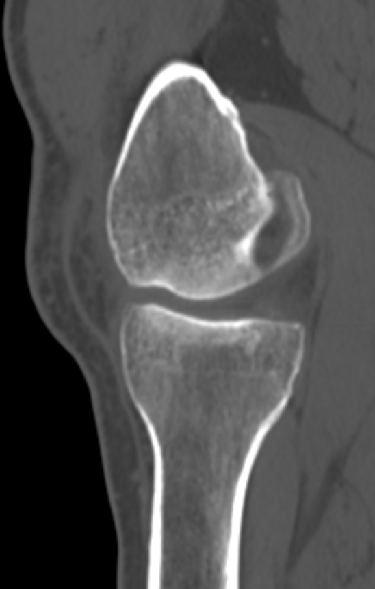 Chondrocalcinosis (Radiopaedia 82862-97173 Sagittal bone window 22).jpg