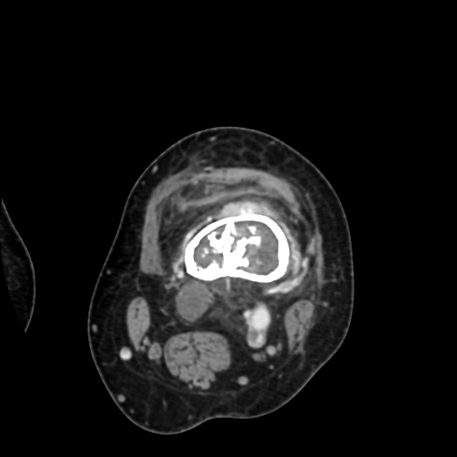 Chondrosarcoma - femur (Radiopaedia 64187-72954 Axial with contrast 30).jpg