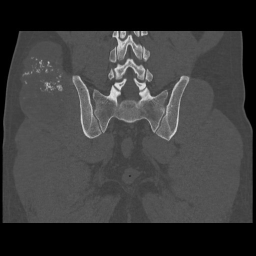 Chondrosarcoma of iliac wing (Radiopaedia 63861-72599 Coronal bone window 83).jpg