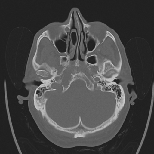 Chondrosarcoma of skull base- grade II (Radiopaedia 40948-43653 Axial bone window 7).png