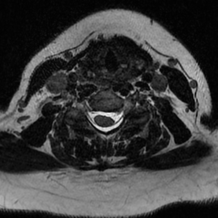 Chordoma - cervical spine (Radiopaedia 70084-80111 Axial T2 56).png