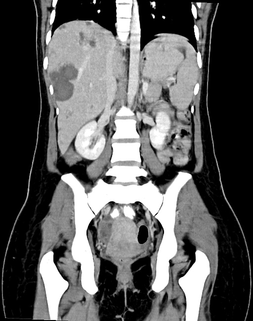 Choriocarcinoma liver metastases (Radiopaedia 74768-85766 B 63).jpg