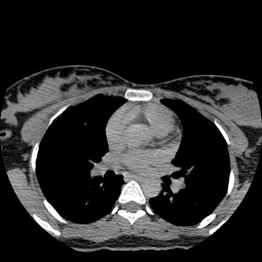 File:Choriocarcinoma of ovary with cerebral and pulmonary metastases (Radiopaedia 25983-26119 Axial non-contrast 136).jpg