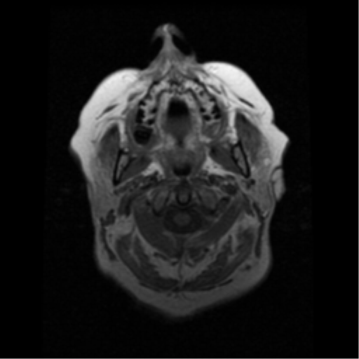 File:Choroid plexus papilloma (Radiopaedia 33040-34052 Axial T1 1).png