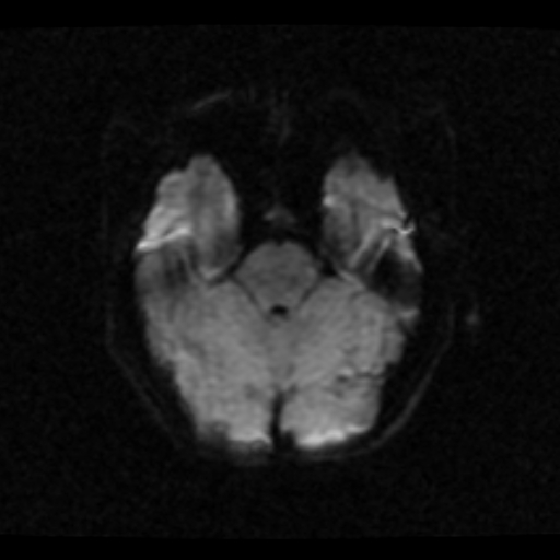 File:Choroid plexus xanthogranuloma (Radiopaedia 17650-17386 DWI 17).jpg