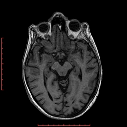 File:Choroid plexus xanthogranuloma (Radiopaedia 67843-77270 Axial T1 98).jpg